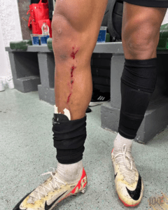 Perna de Cuello, do Athletico, sangrando após dividida em jogo contra o Juventude