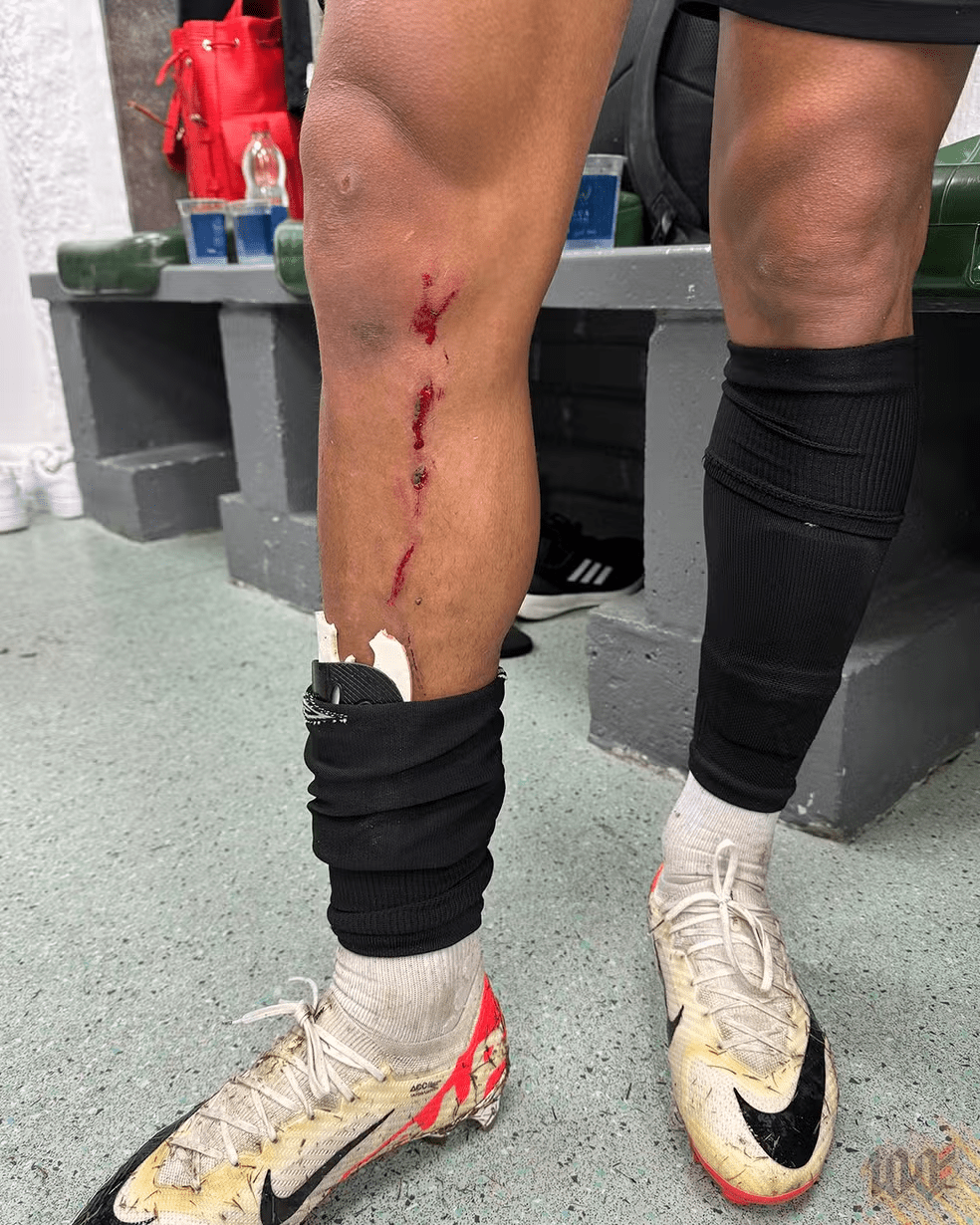 Athletic Cuello's leg, bleeding after divided into the game against Youth